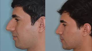 Male Rhinoplasty: Reducing the Hump | Anthony Bared, MD, FACS Miami, FL