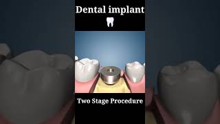 tooth implant process animation | full procedure implant #new