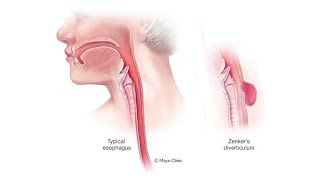 Zenker's Diverticulum: Expert Insights from Mayo Clinic's Dale Ekbom