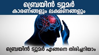 ബ്രെയിൻ ട്യൂമർ ലക്ഷണങ്ങളും കാരണങ്ങളും | Brain Tumor Symptoms and Causes Malayalam