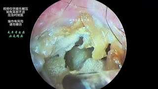 Treat the cerumen on the eardrum and the blocked external auditory canal | 519