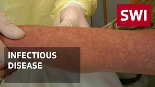 Why some Swiss people still get measles