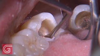HOW TO Clean Up Severe Occlusal  Decay on TOOTH #31: 1 of 2