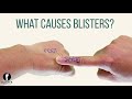 what causes blisters on feet