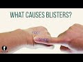 what causes blisters on feet