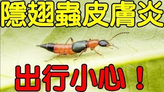 隱翅蟲皮膚炎，出遊踏青要留意！｜健康享知識《享知識TV》