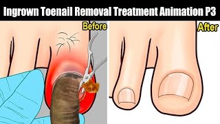 ASMR 시원함 주의! 리얼한 내성 발톱 케어 애니메이션 | Ingrown Toenail Removal Treatment Animation P3 / HA Relaxing