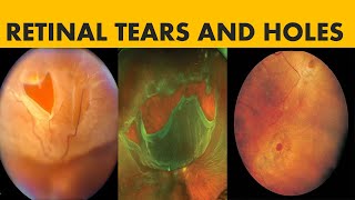 Retinal Breaks | Horseshoe shaped Tears, Atrophic holes, operculated holes, Giant tears and Dialysis