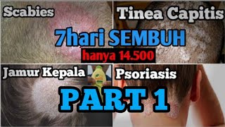 Part 1 |Obat Segala Penyakit Jamur Kepala (kinia capitis, jamur kepala , Scabies, & kerak kepala)