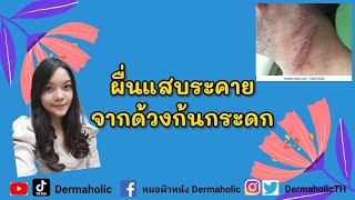 ผื่นแสบระคายจากด้วงก้นกระดก | หมอแนน @Dermaholic