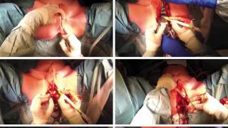 “Pros and Cons of Laparoscopic Vaginoplasty”– Video Discussion by John G. Hunter, MD, MMM