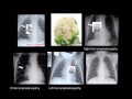 Paediatric TB Xrays (part 1) - clues from the frontal film by Savvas Andronikou