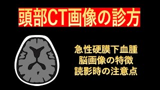 頭部CT画像の診方-急性硬膜下血腫の特徴と読影時の注意点-