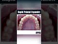 RAPID PALATAL EXPANDER - ORTHODONTIC TIPS #Shorts