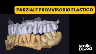 Exocad Tutorials | Temporary elastic partial