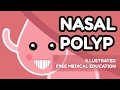 What is Nasal Polyp?