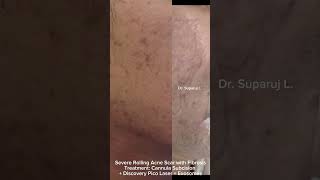 Severe Rolling Acne Scar Fibrosis Treatment: Cannula Subcision + Discovery Pico Laser + Exosomes