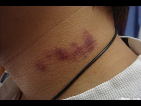 how to make a hickey go away in 5 minutes how to make a hickey go away in 5 minutes