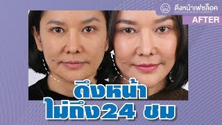 รีวิวดึงหน้า Facelift เฟซล็อค ไม่ถึง 24ชั่วโมง!! เคยทำตาไป10ปีและดึงหน้าไป7ปีที่แล้ว ธีรพรคลินิก