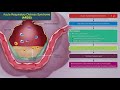 acute respiratory distress syndrome ards etiology clinical features diagnosis and treatment