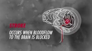 Warning Signs of A Stroke - Oneida Healthcare