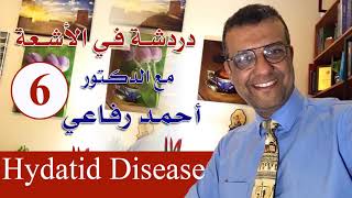 دردشة فى الاشعة 6 -  Hydatid disease - د. أحمد رفاعي