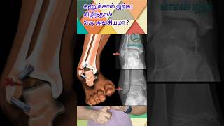 கணுக்கால் சுழுக்கு - Xray ஏன் செய்யணும் | Ligament tear in Xray | கணுக்கால் ஜவ்வு கிழிதல் #sprain