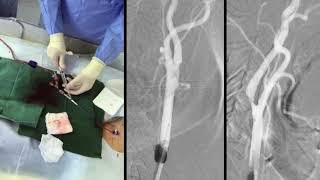 Balloon-Guide Catheter Protected Carotid Stenting