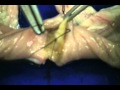 Double layer Bowel Anastomosis