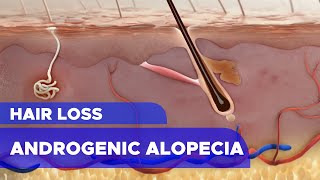 Hair Loss: Androgenic Alopecia