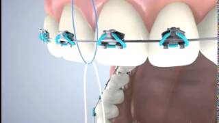 Floss Threaders By DenTek