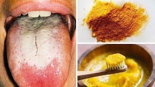 Use This Natural Paste And Remove The White Coating On Your Tongue