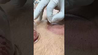 Hijama kaise kre