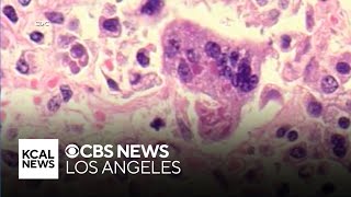 Measles case reported at LAX