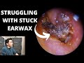 Struggling With Impacted Ear Wax Removal