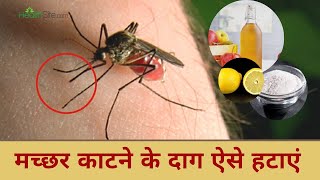 Mosquito Bite: मच्छरों काटे के निशानों को हटाने के लिए अपनाएं यह घरेलू उपाय, Watch Video