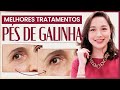 RUGAS PÉ DE GALINHA | Como amenizar essas linhas na ÁREA DOS OLHOS