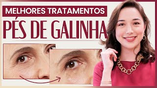 RUGAS PÉ DE GALINHA | Como amenizar essas linhas na ÁREA DOS OLHOS