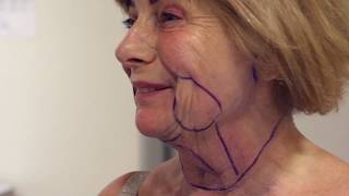 Full Facelift by Dr. Tha-In at Skin+Surgery Clinics - censored