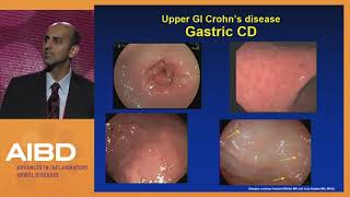 Diagnosing and treating Crohn's disease of the esophagus, stomach, and duodenum