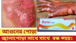 Burna cream.আগুনে পোড়া অ্যাক্সিডেন্টের আঘাতের জ্বালাপোড়া বন্ধ হয়ে যায়।