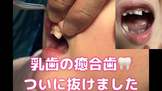 癒合歯抜けました！！6歳8ヶ月で7.8本目の乳歯を抜いてきました🦷