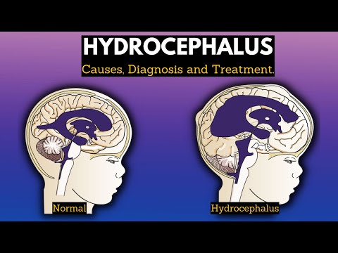 Is hydrocephalus a developmental disability?