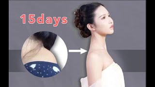 Fix dowager’s hump in 2 weeks🔥get perfect shape of neck and shoulders