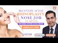 Recovery after Rhinoplasty (Nose Job) surgery - Best Plastic Surgeon in India