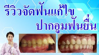 รีวิวจัดฟันแก้ไขฟันยื่น ปากอูม