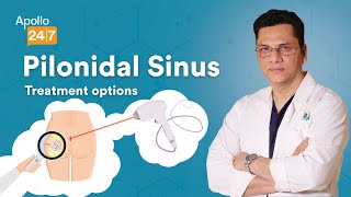 Can Pilonidal Sinus be Treated Without Surgery? | Dr Nitish Jhawar | Apollo 24|7