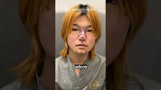 Mtf Facial Feminization Dramatic Transformation Koreanplasticsurgery
