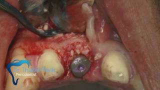 Mucoderm matrix with immediate extraction \u0026 Straumann implant placement