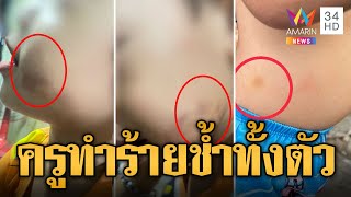 แม่ร้องลูกโดนครูทำร้ายแผลเต็มตัวผวาไม่กล้าไปเรียน ครูหยิกแก้มต่อหน้า | ข่าวเที่ยงอมรินทร์ |30ก.ค.66